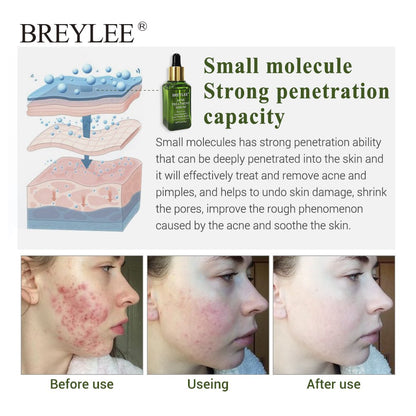 Acne Facial Treatment