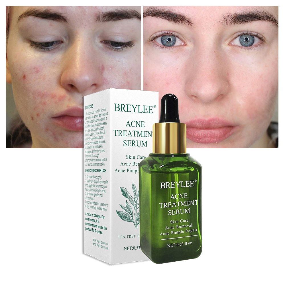 Acne Facial Treatment